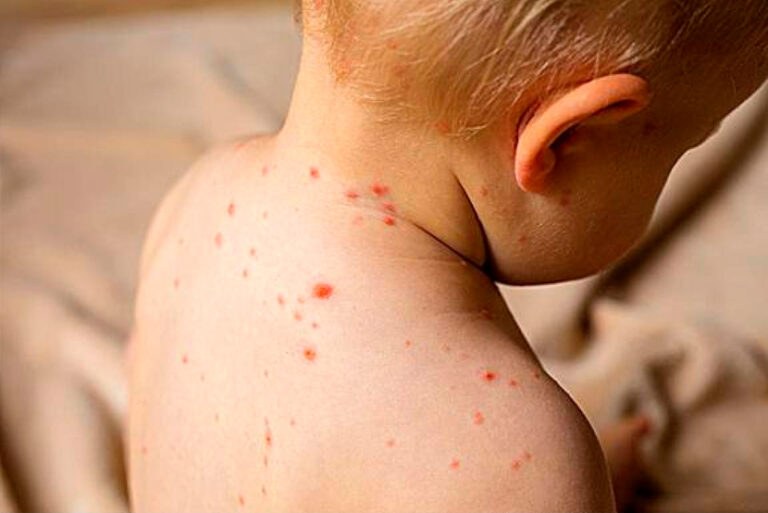 Minsal advierte por aumento de sarampión en la región y refuerza alerta epidemiológica